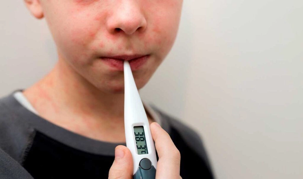 Emite Ssa el tercer aviso epidemiológico por sarampión