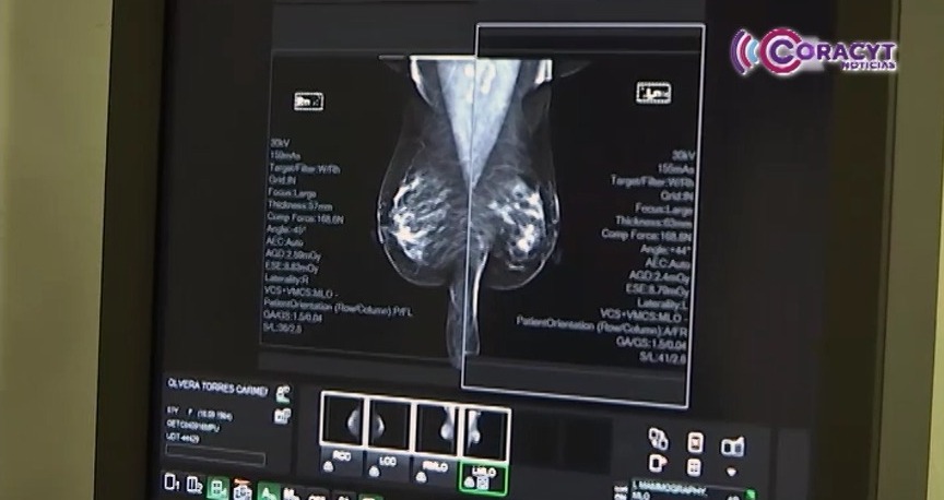 Realiza Issste Tlaxcala alrededor de 80 mastografías semanales