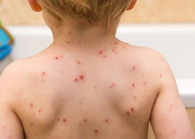 México mantiene bajo control el brote de sarampión; Chihuahua concentra 88% de los casos