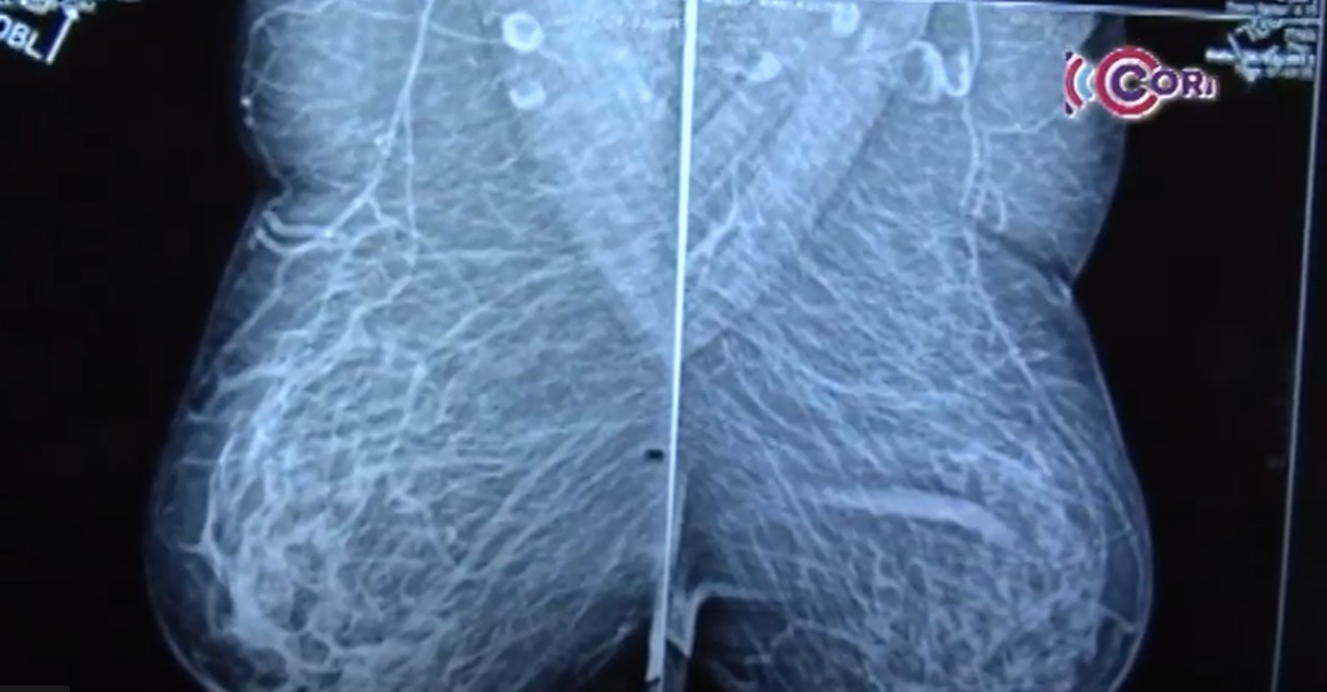 Ofrece IMSS Tlaxcala mil mastografías a mujeres derechohabientes durante el