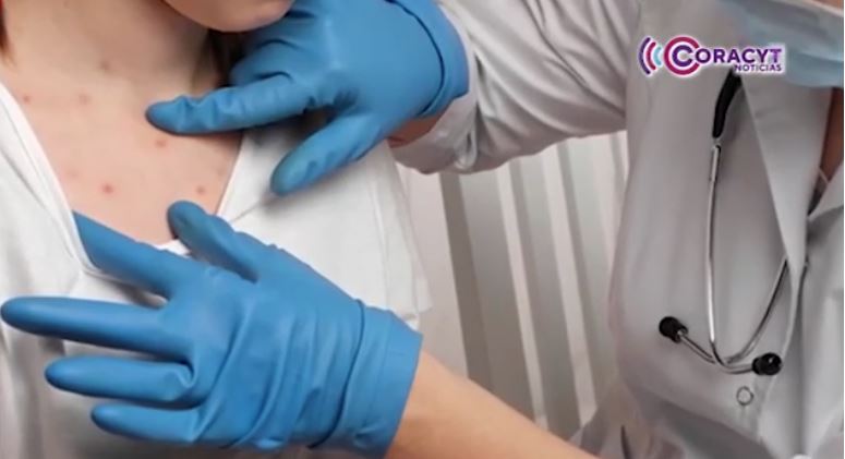 Refuerzan vacunación contra el sarampión en Tlaxcala