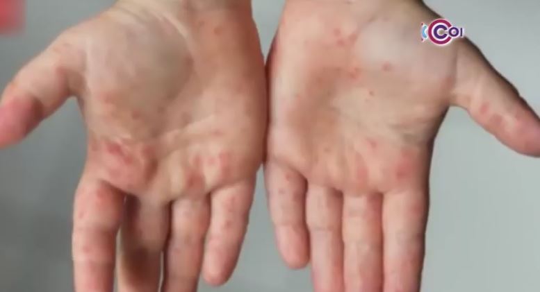 Registra Sector Salud 15 casos del virus Coxsackie en Tlaxcala