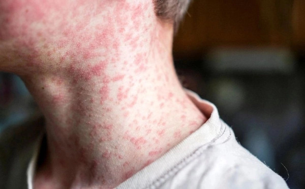 Por brote de sarampión, suspenden acceso en centro de detención de migrantes en Texas